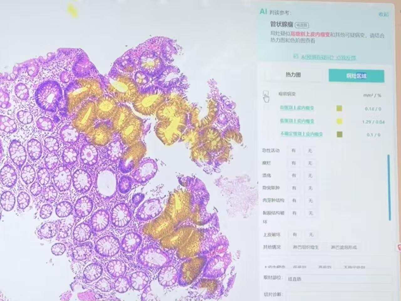 从“用AI”到“造AI”：智慧医疗如何重塑广州医生工作日常？